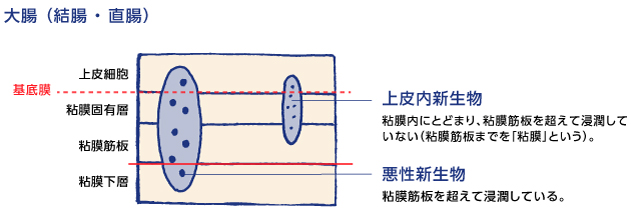 大腸(結腸・直腸)